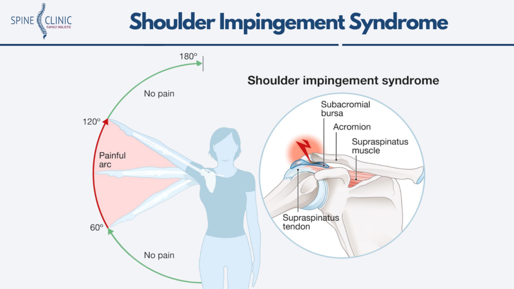 Shoulder Impingement Syndrome Cara Penanganan Bahu Nyeri