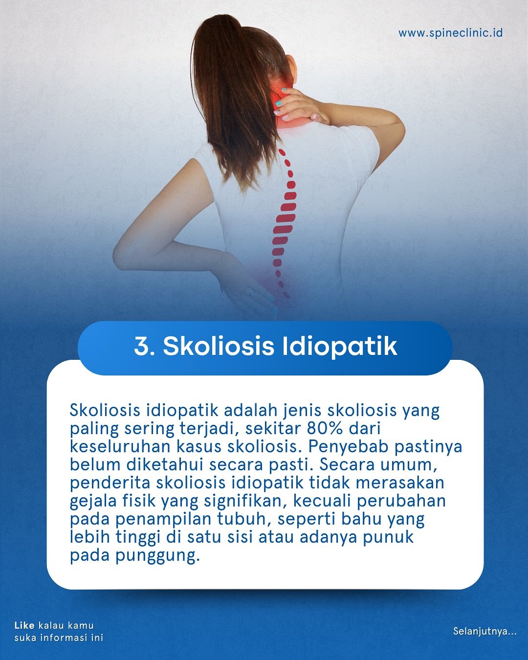 Skoliosis Idiopatik