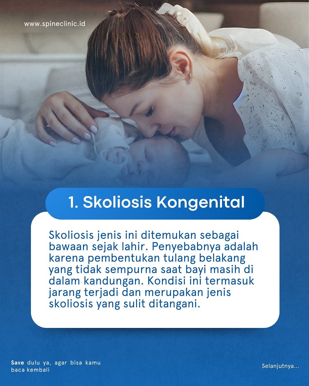 Skoliosis Kongenital