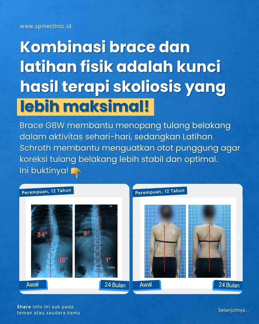 kombinasi brace gbw dan terapi fisik untuk menyembuhkan skoliosis