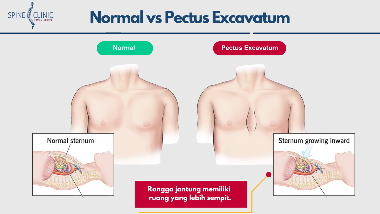 Pectus Excavatum atau dada cekung