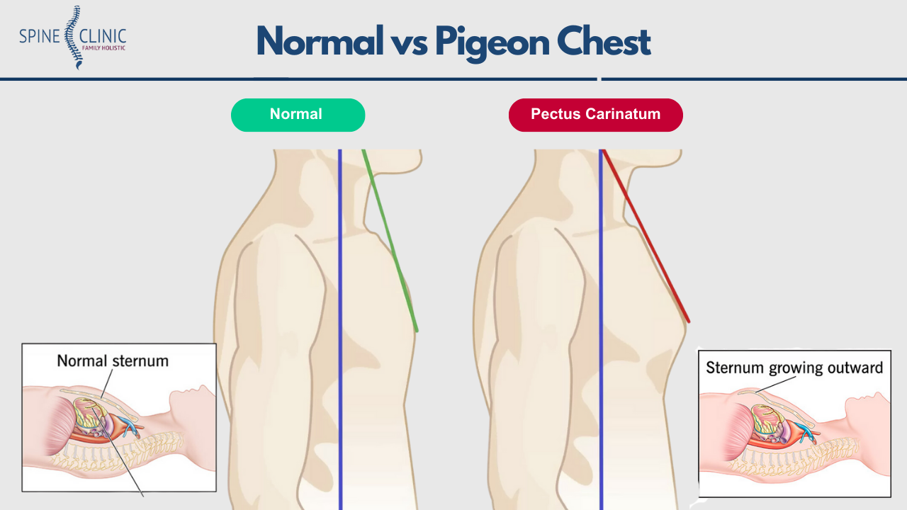 bentuk dada pigeon chest