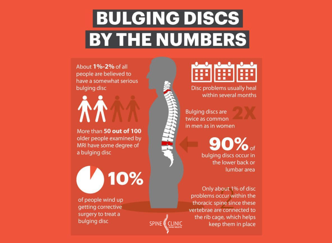 bulging disc infografik