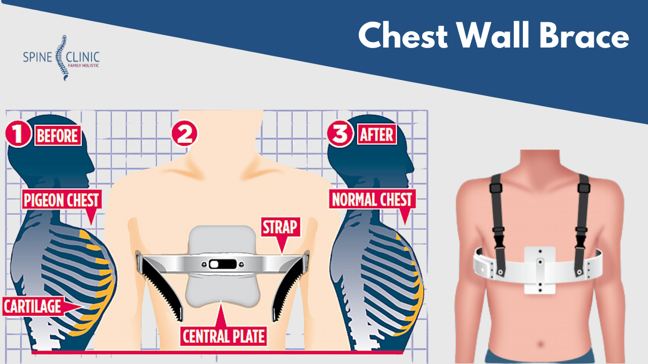 chest wall brace untuk pigeon chest