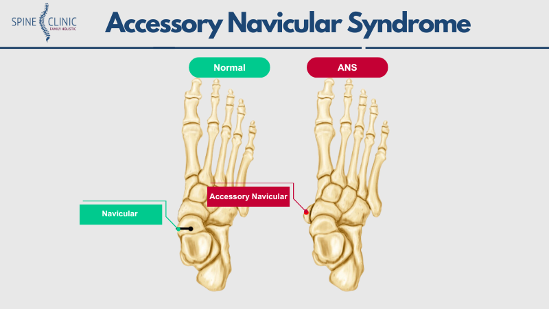 Accessory Navicular Syndrome adalah