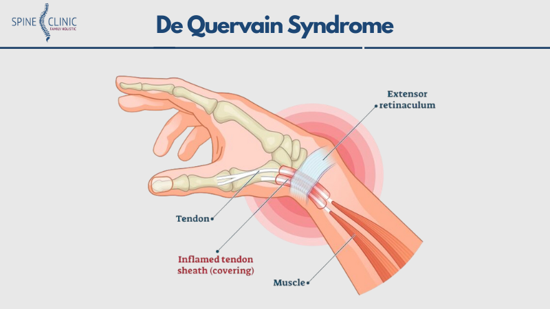 De Quervain Syndrome