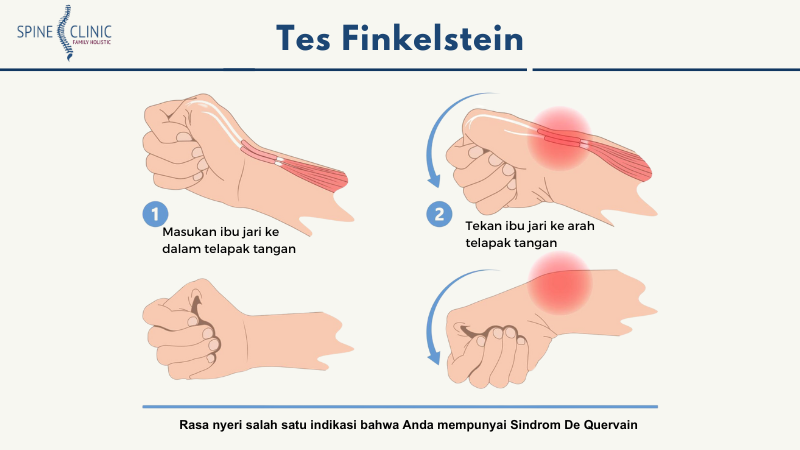 Tes Finkelstein De Quervain Syndrome