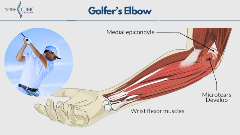 golfer elbow adalah
