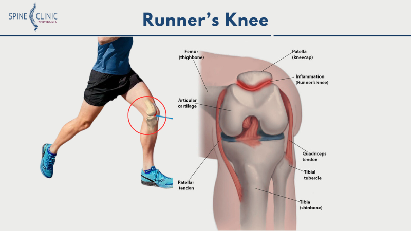 runner's knee adalah