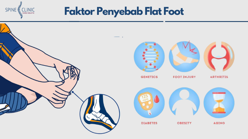 Faktor Penyebab Flat Foot