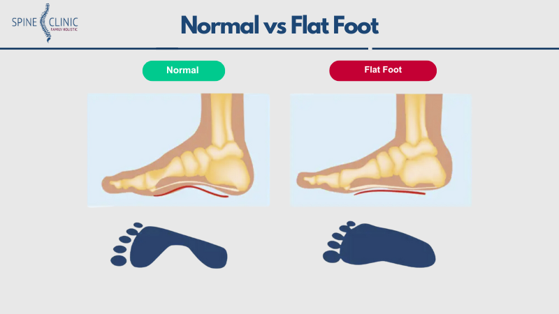 Flat Foot adalah