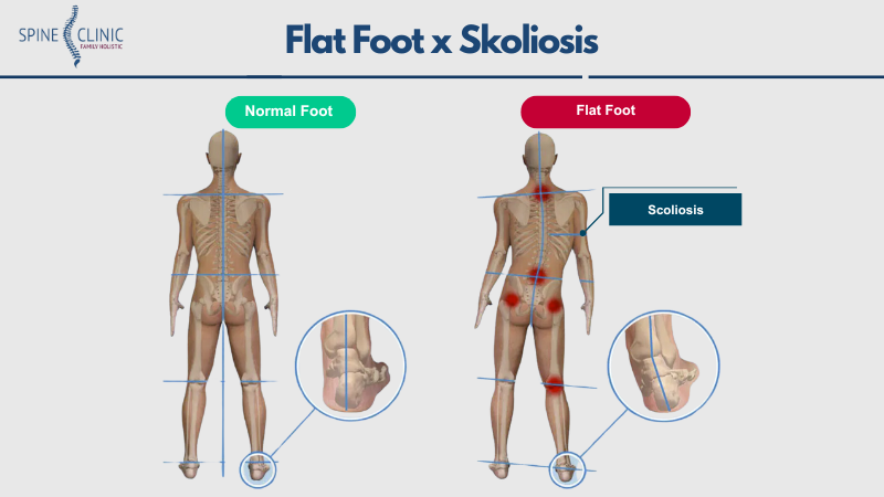 flat foot menyebabkan skoliosis