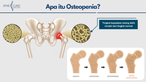 Apa itu Osteopenia? Penyebab, Gejala, dan Penanganan