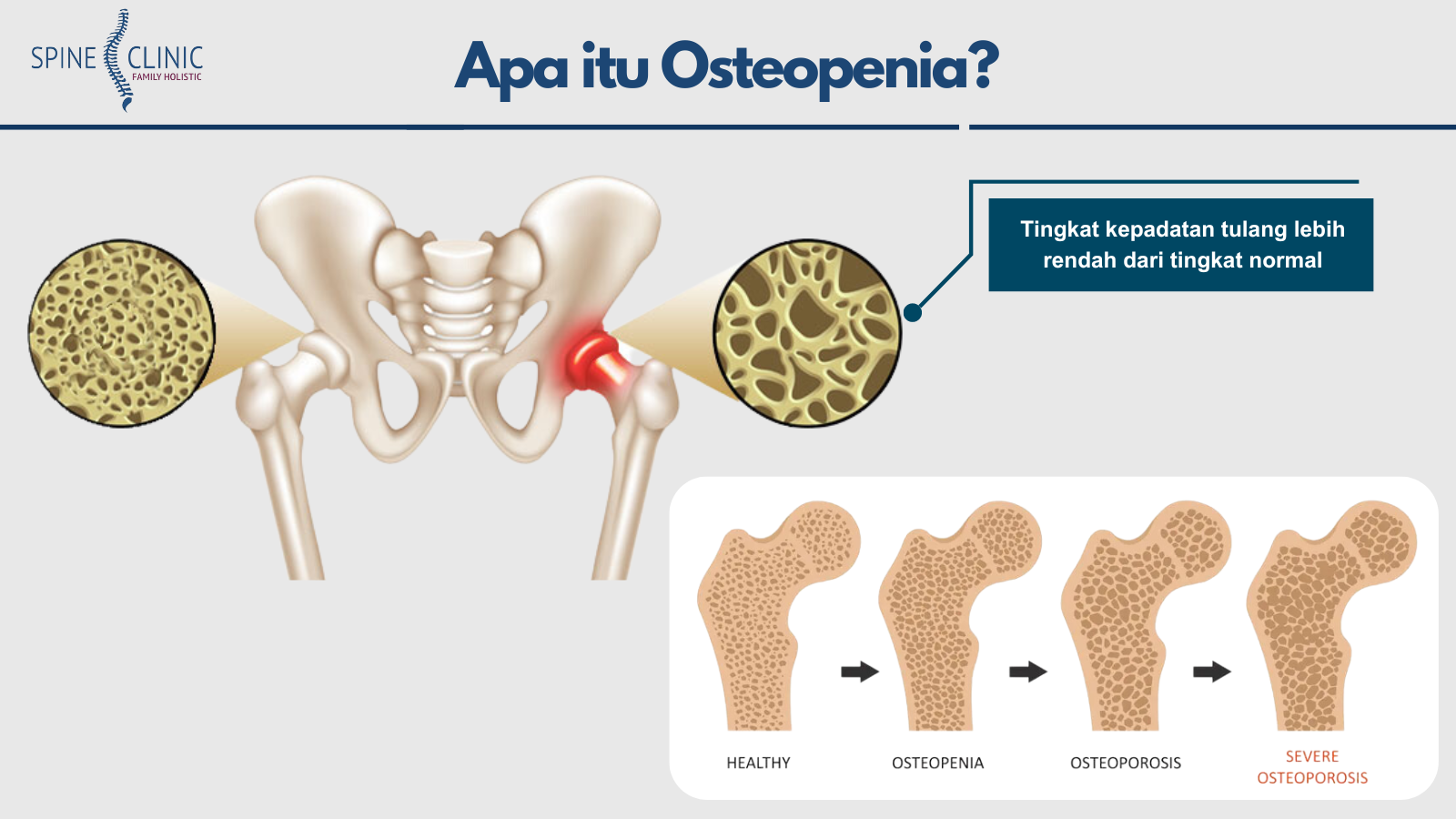 Osteopenia adalah