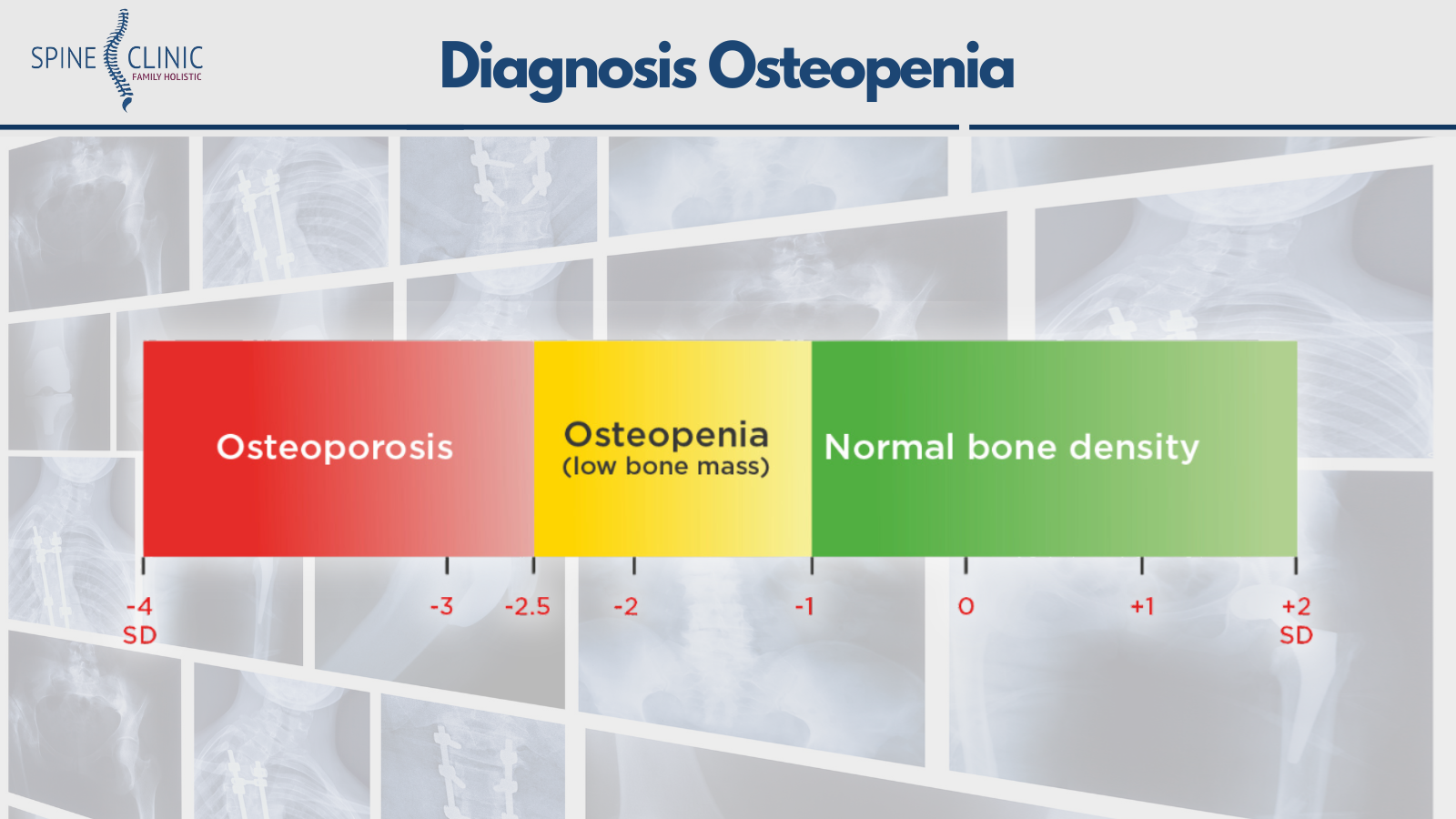 diagnosis osteopenia dengan t dan z score