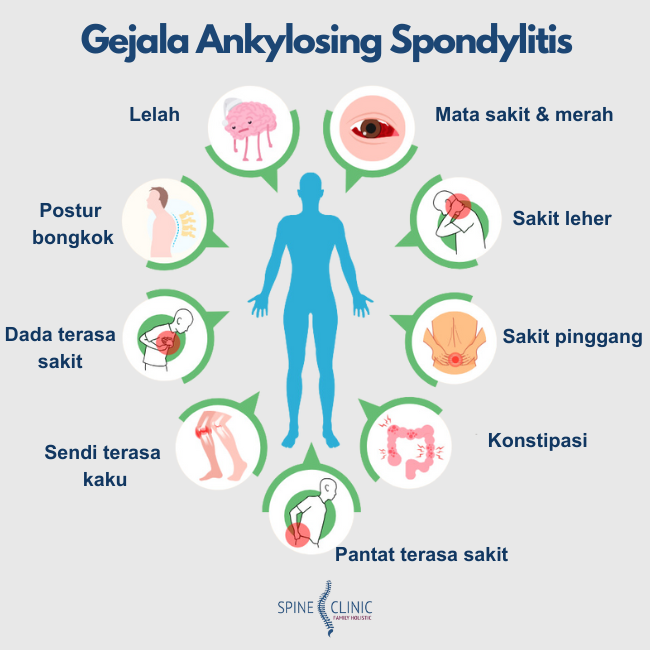 Gejala Ankylosing Spondylitis atau bamboo spine