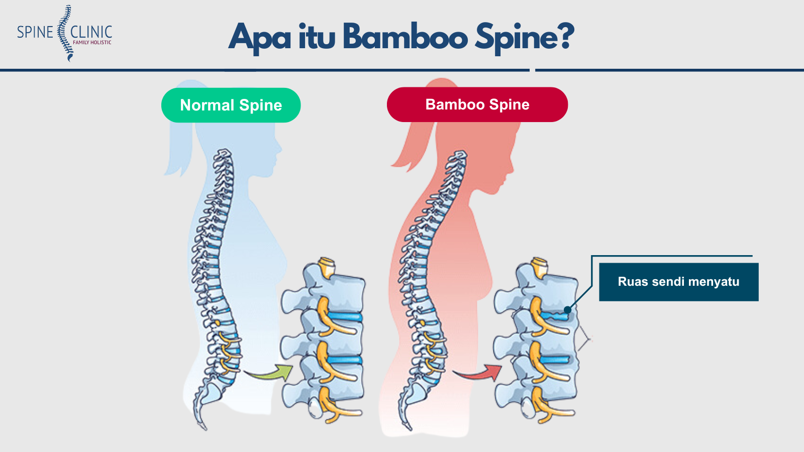 bamboo spine adalah