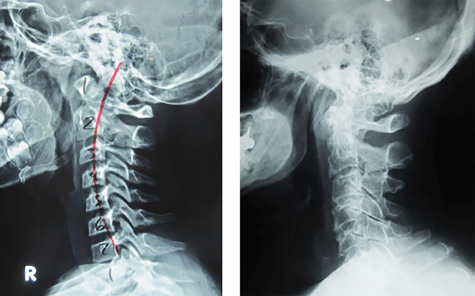 bamboo spine dalam x ray