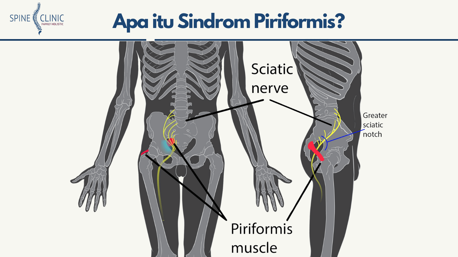 nyeri pangkal paha - sindrom piriformis