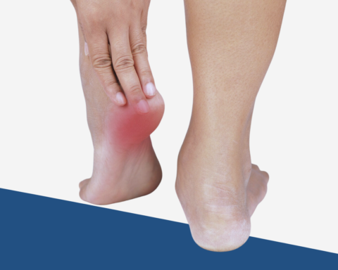 Plantar Fasciitis