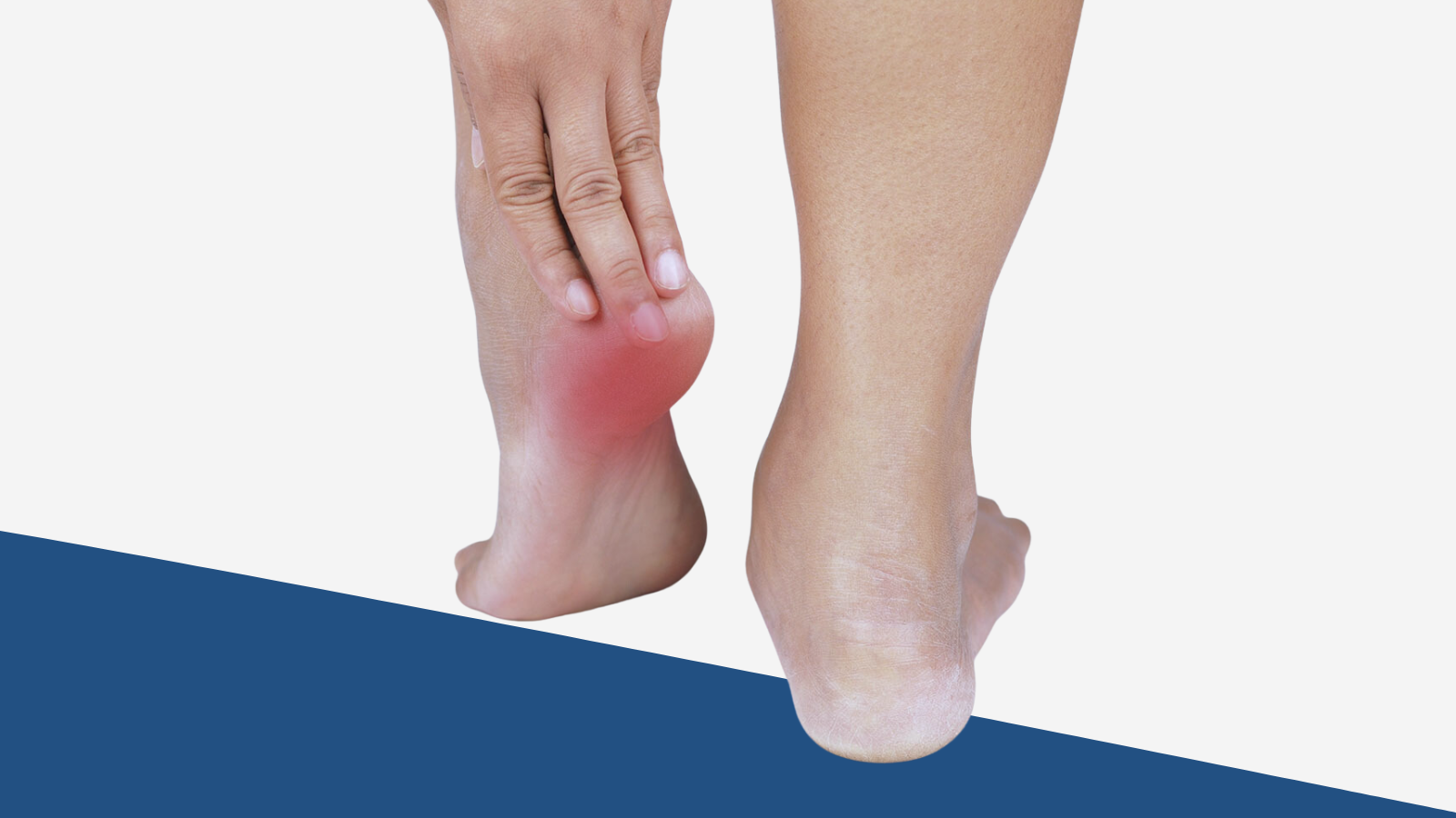 Plantar Fasciitis