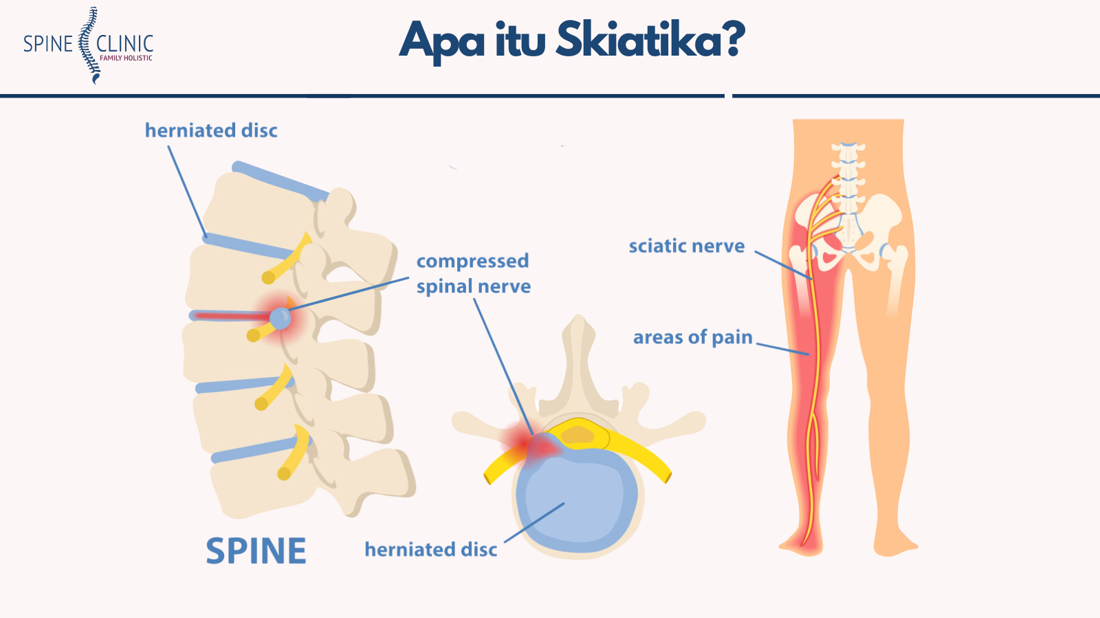 skiatika adalah