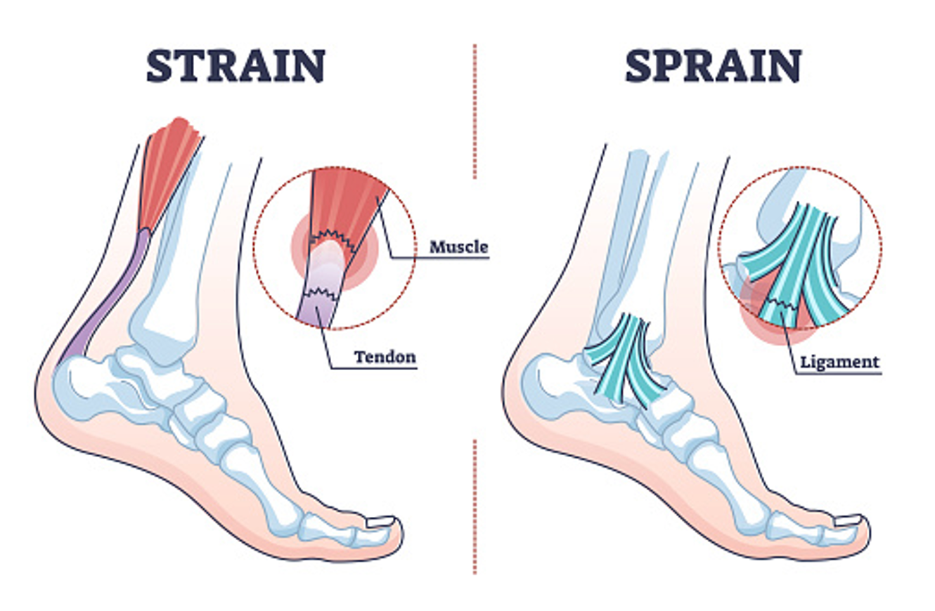 sprain vs stain