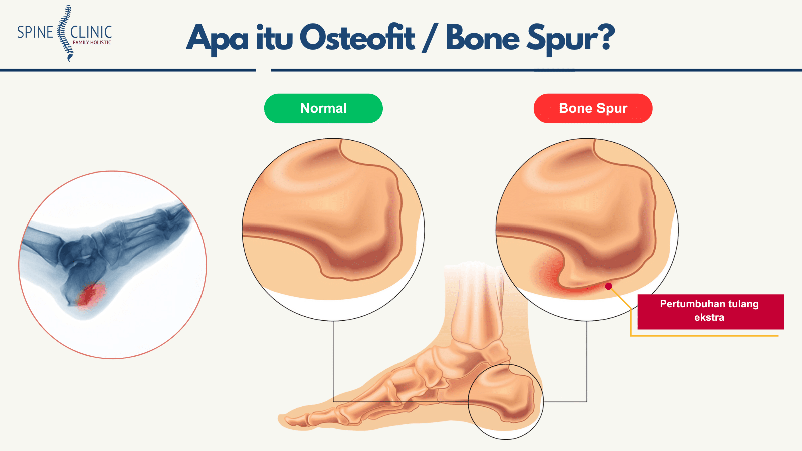 bone spur adalah