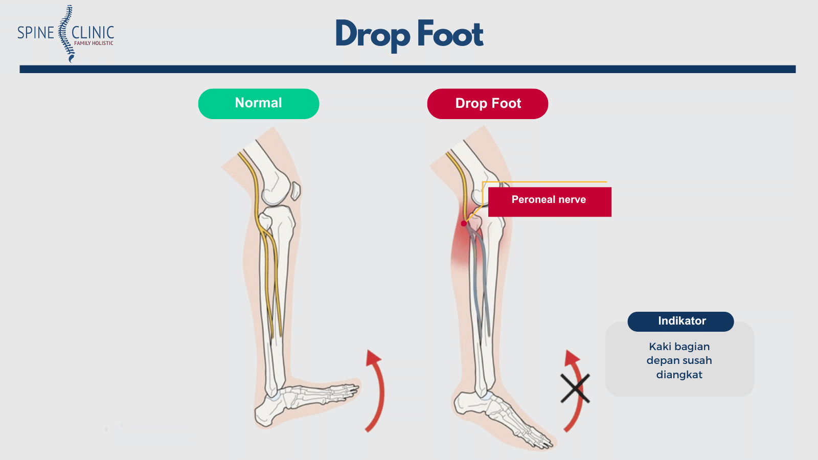 drop foot adalah