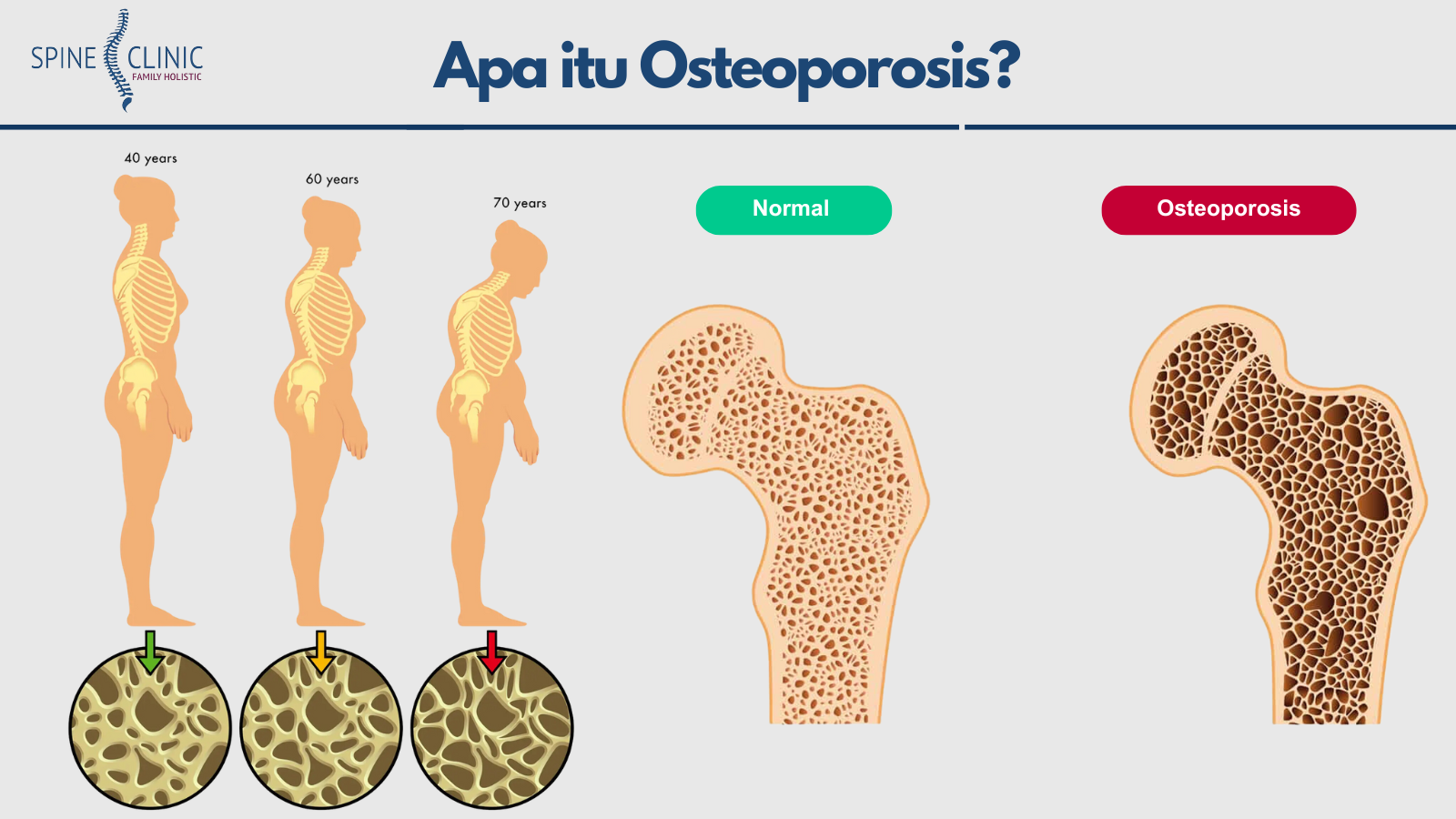 osteoporosis adalah