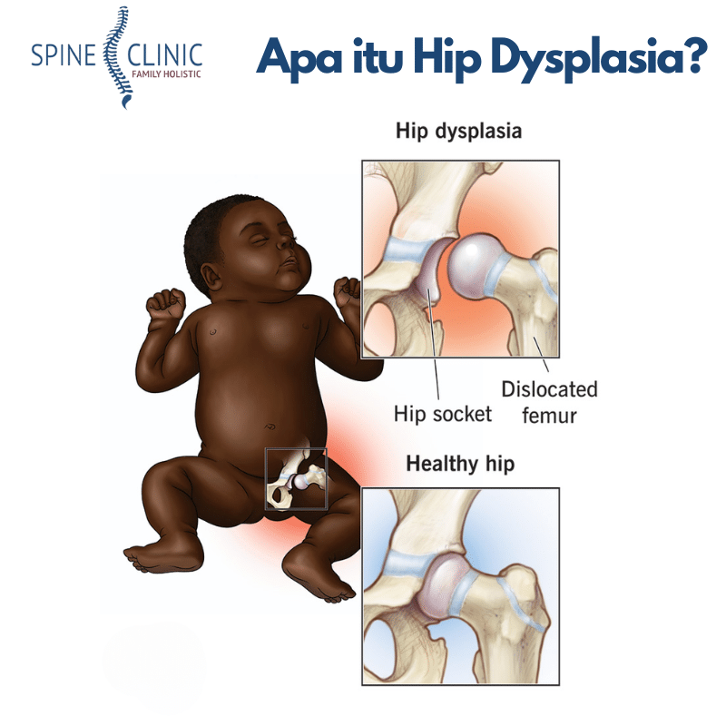 Hip Dysplasia adalah