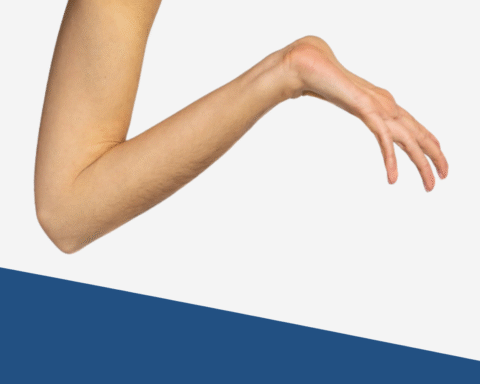 Marfan Syndrome