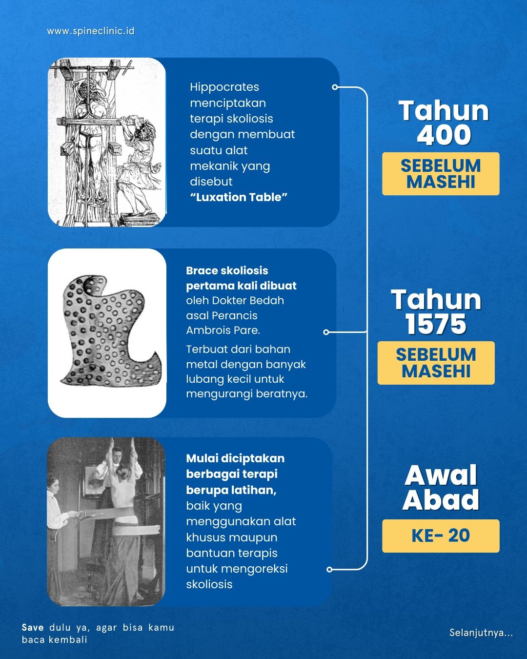 pengobatan skoliosis jaman dulu