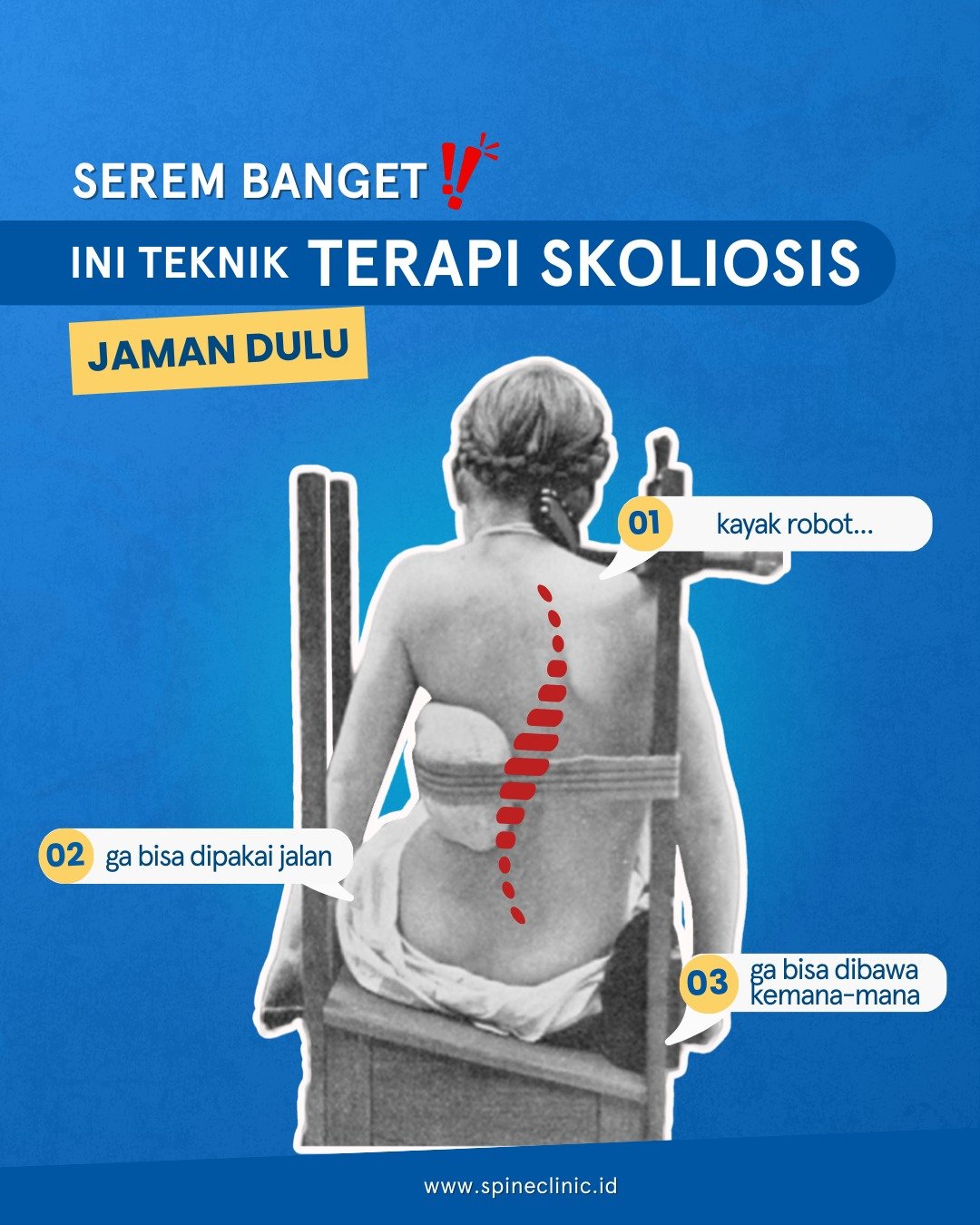 teknik terapi skoliosis jaman dulu