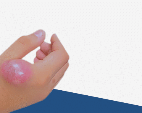 Ewing Sarcoma