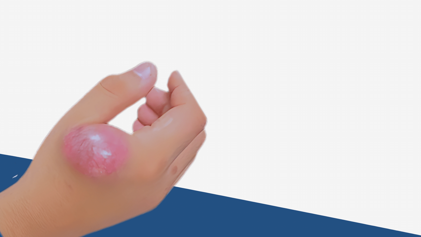 Ewing Sarcoma