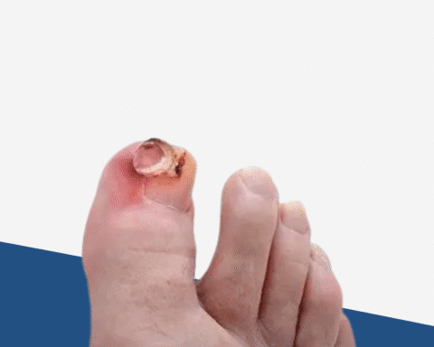Exostosis