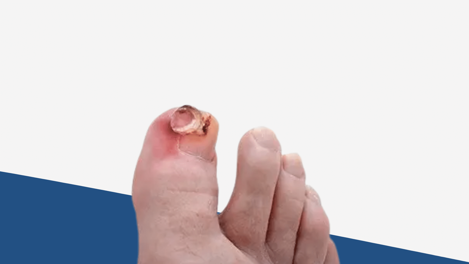 Exostosis
