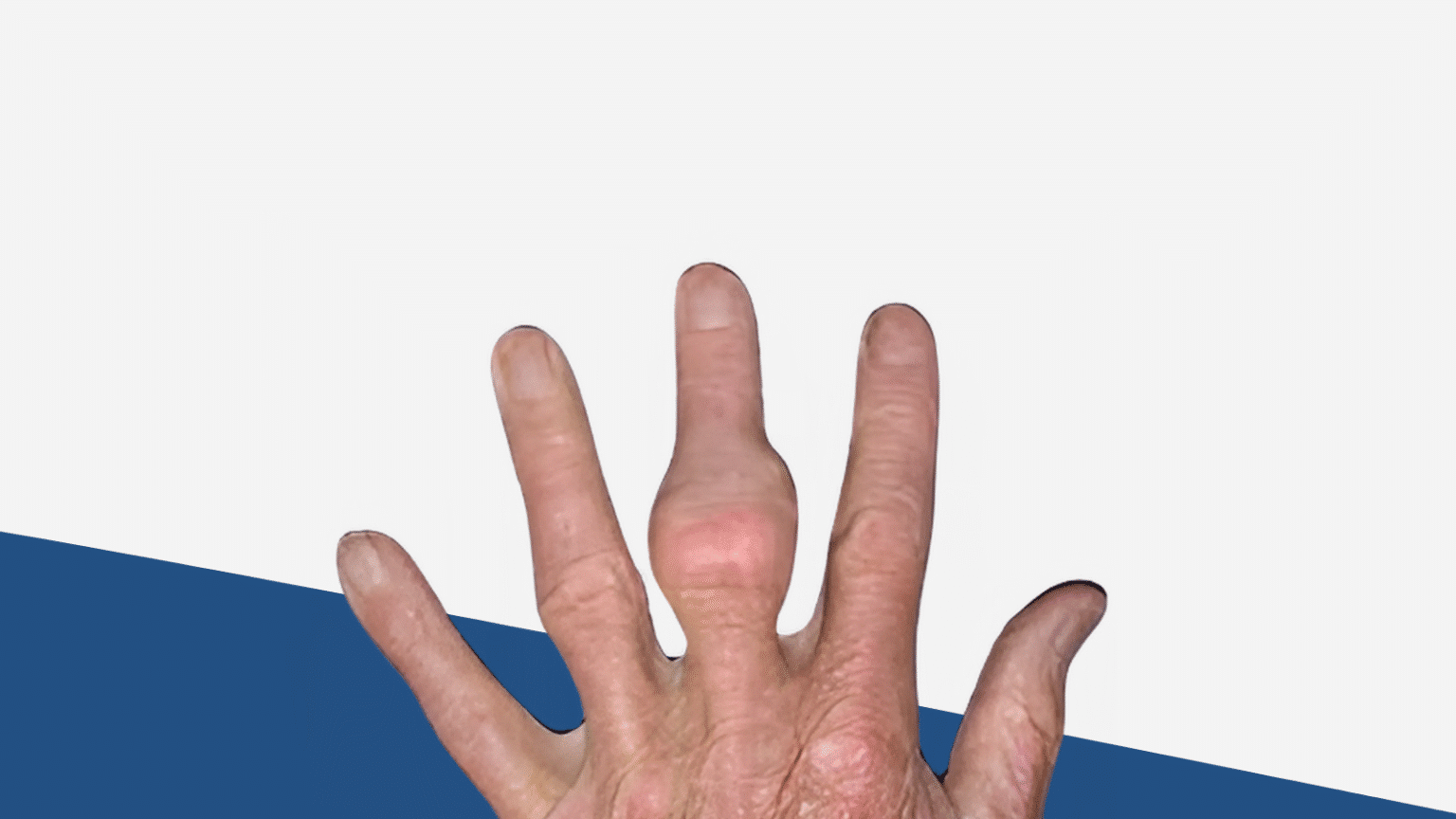 Gouty Tophi: Penyebab, Gejala, dan Cara Mengobatinya