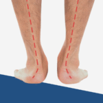Overpronation