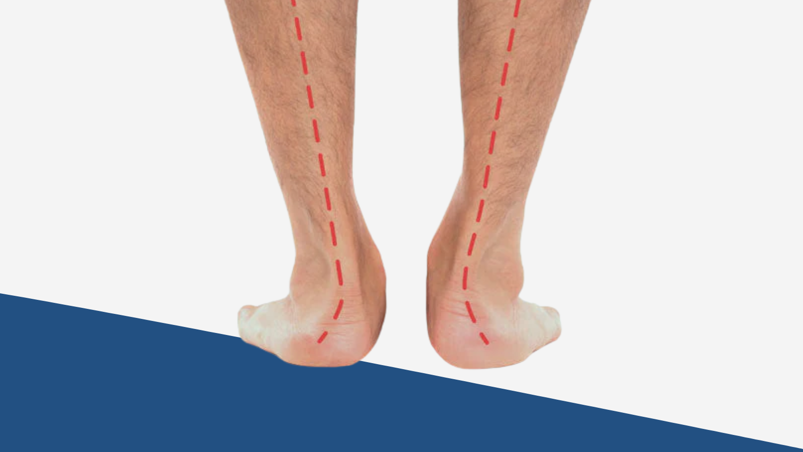 Overpronation