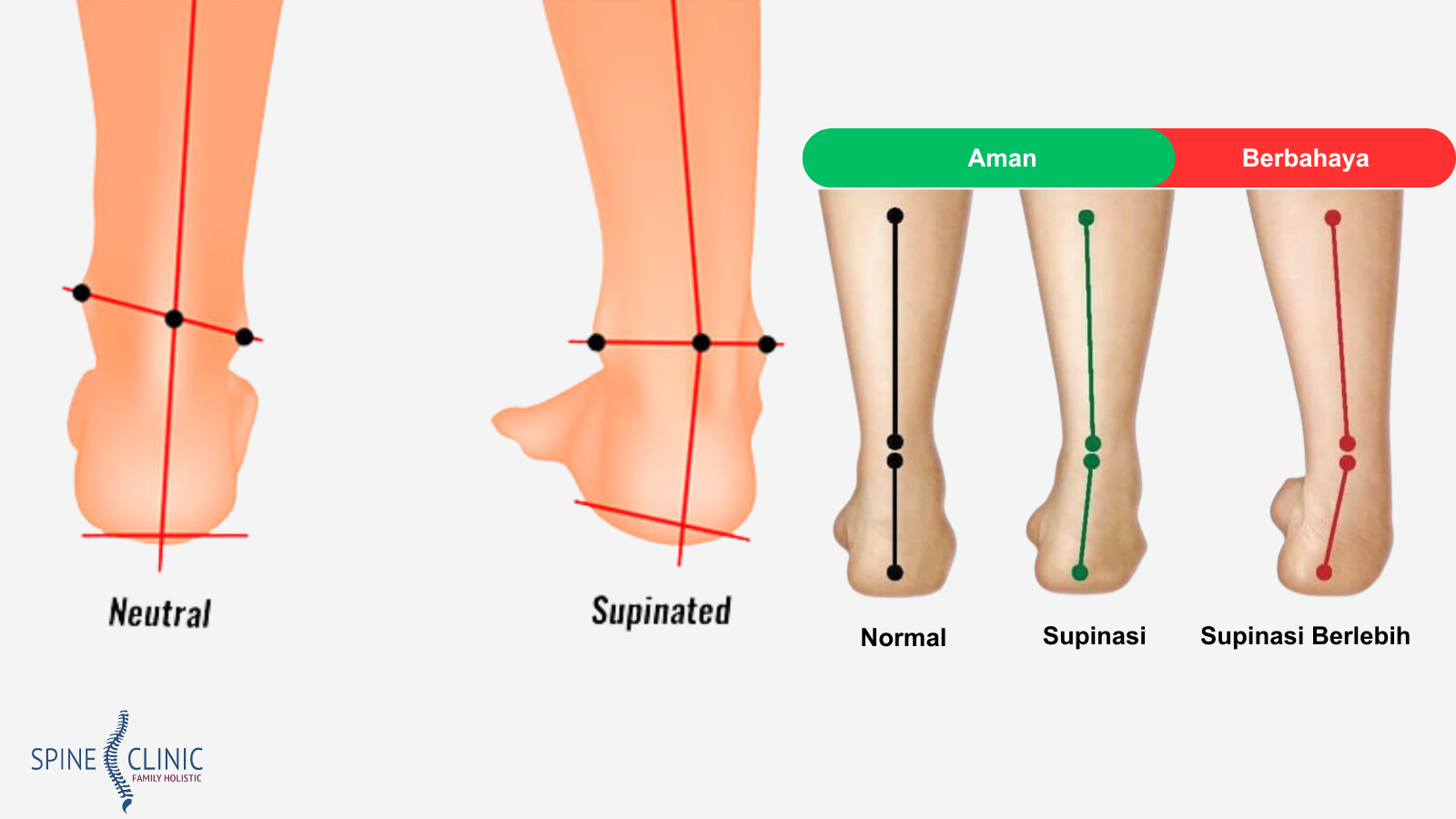supinasi kaki adalah