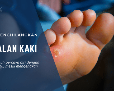 cara menghilangkan kapalan di kaki