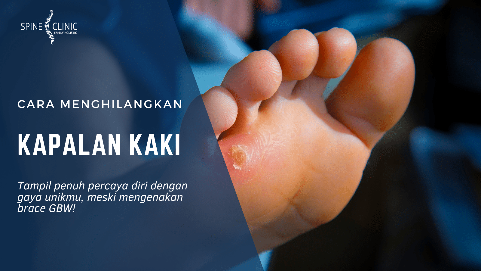 cara menghilangkan kapalan di kaki