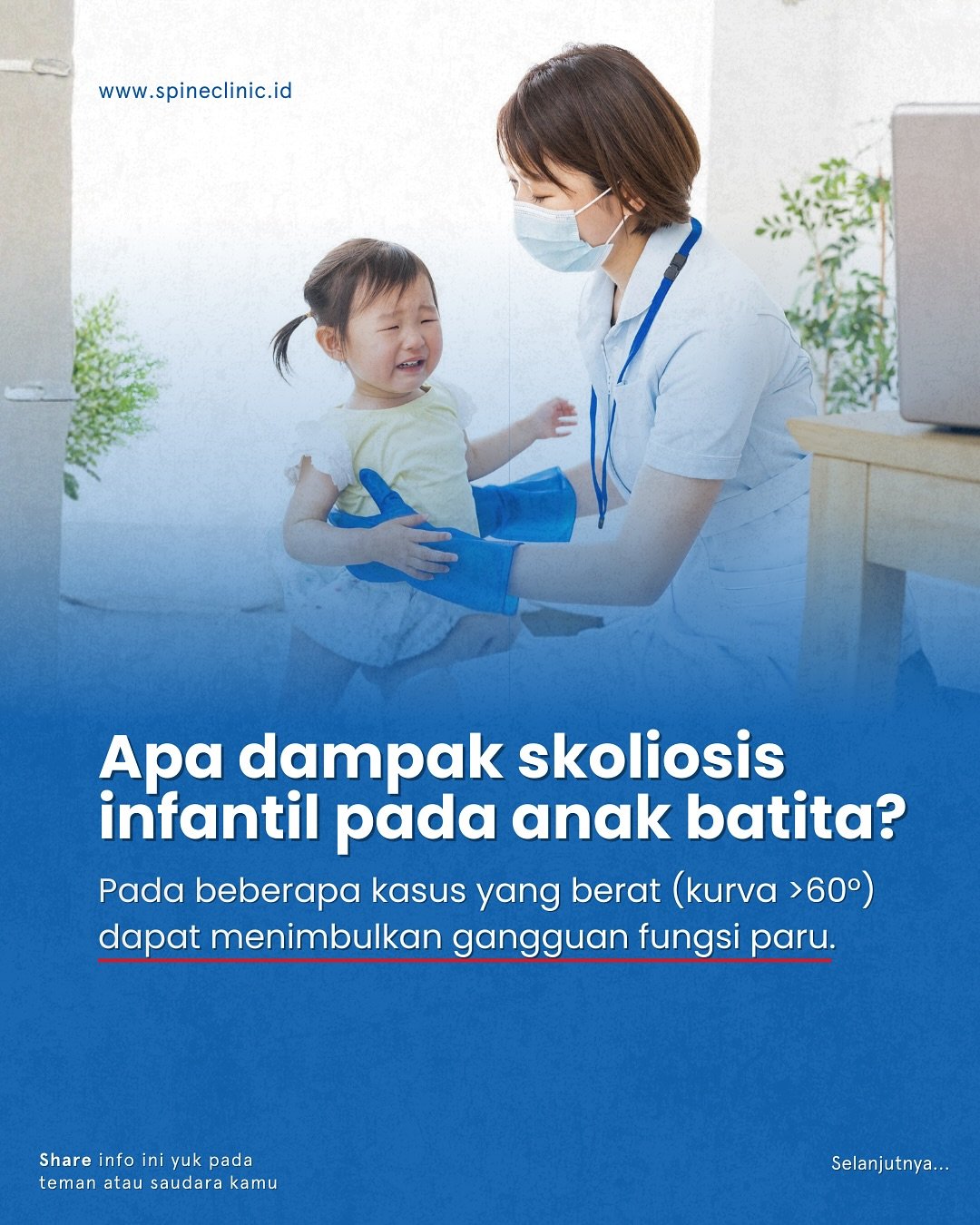 dampak skoliosis pada anak batita