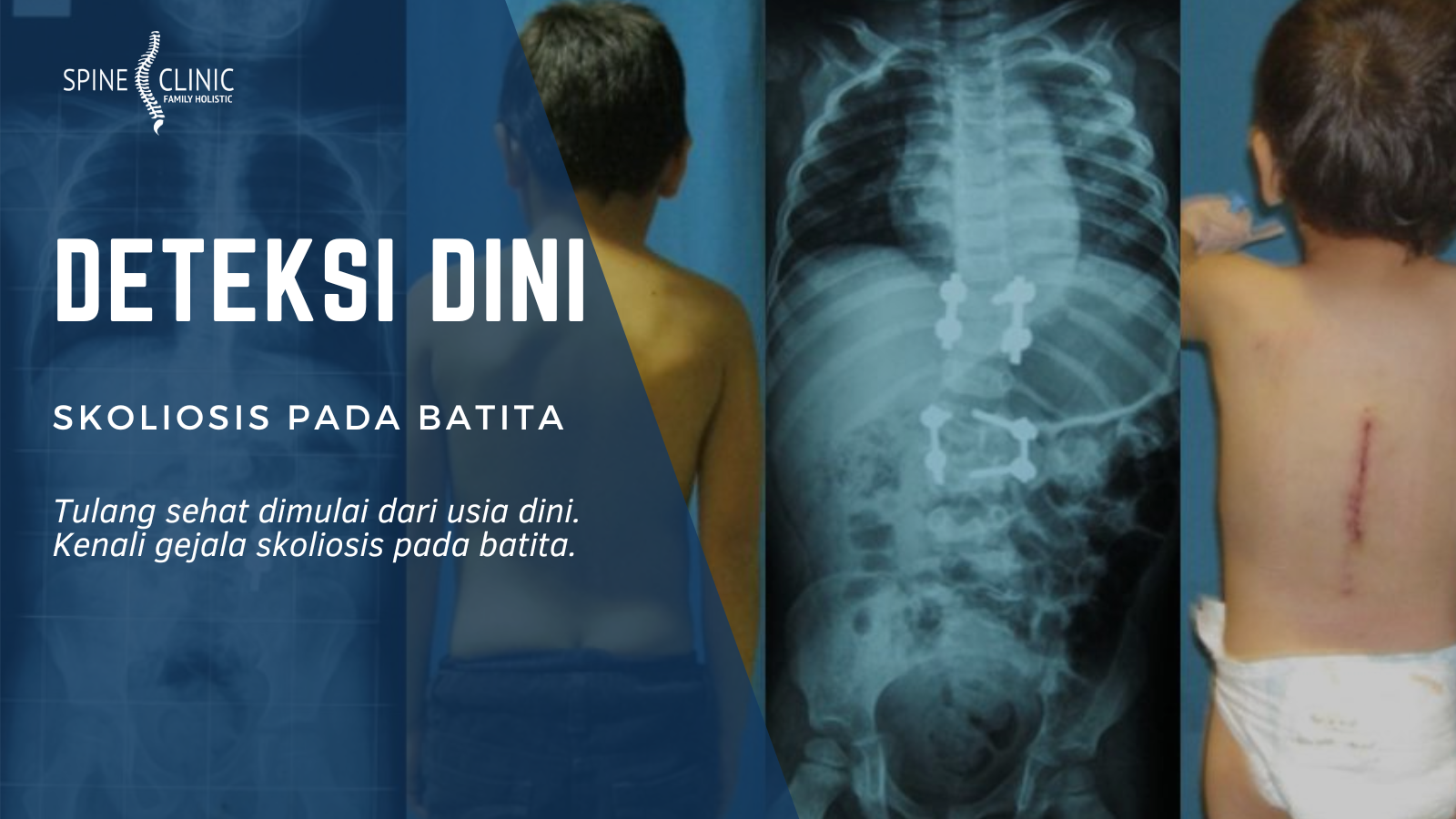 skoliosis pada batita