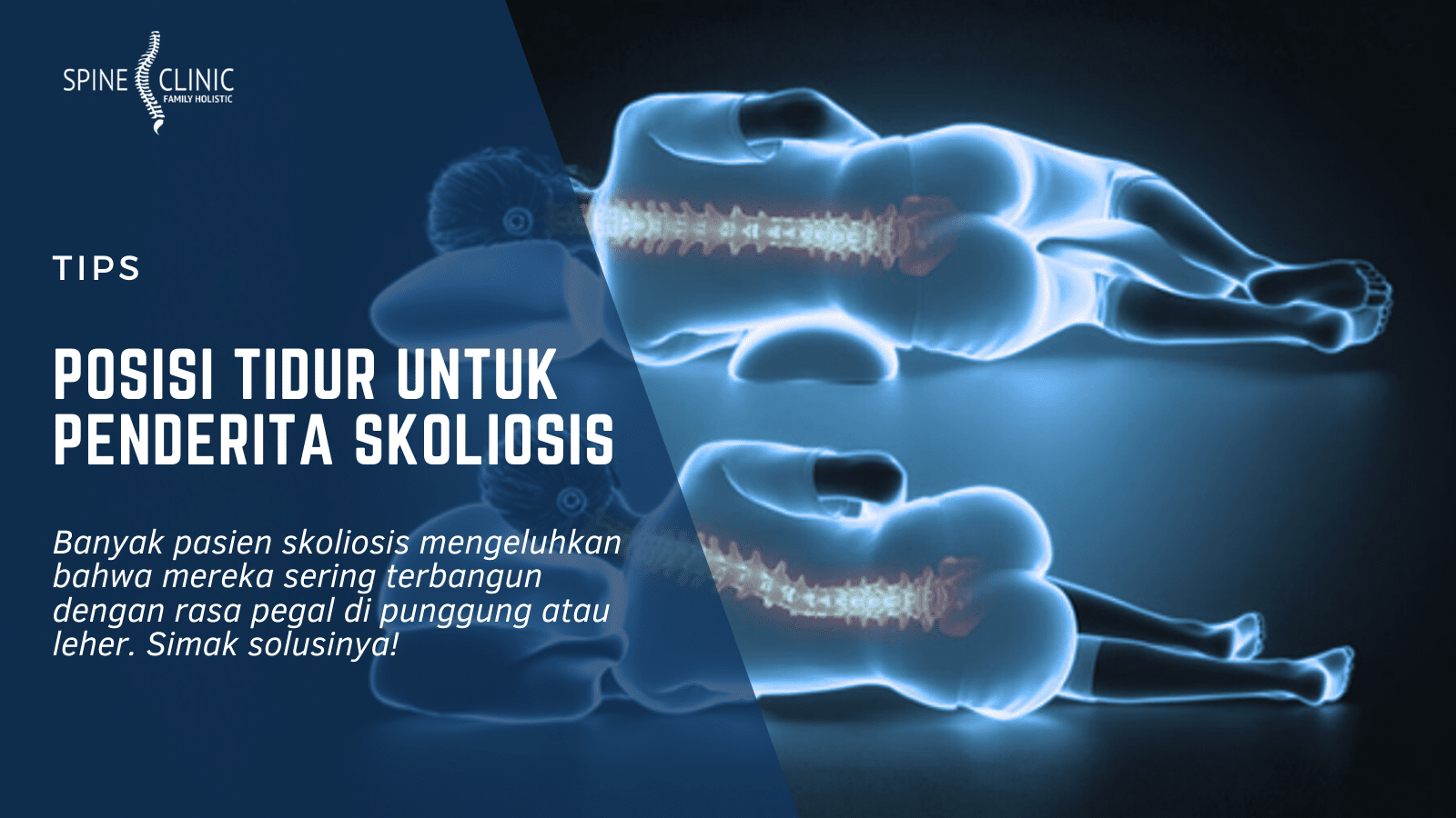 tips posisi tidur untuk penderita skoliosis