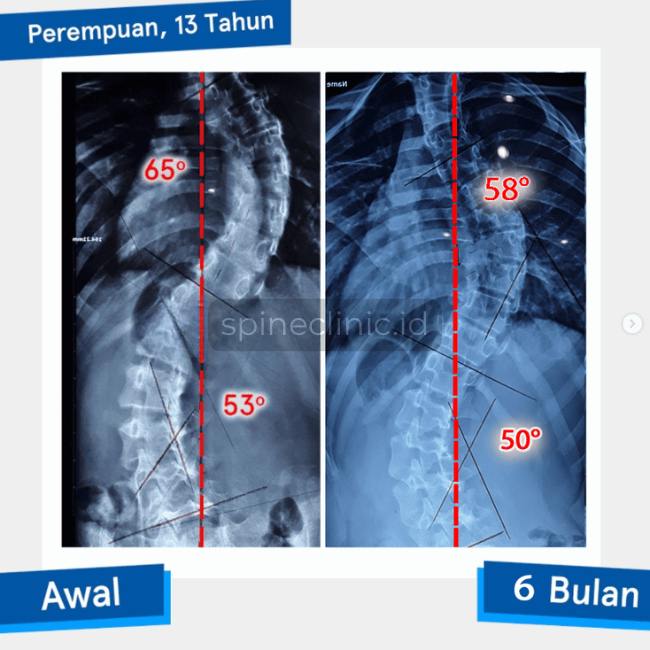 Studi Kasus Pada skoliosis berat