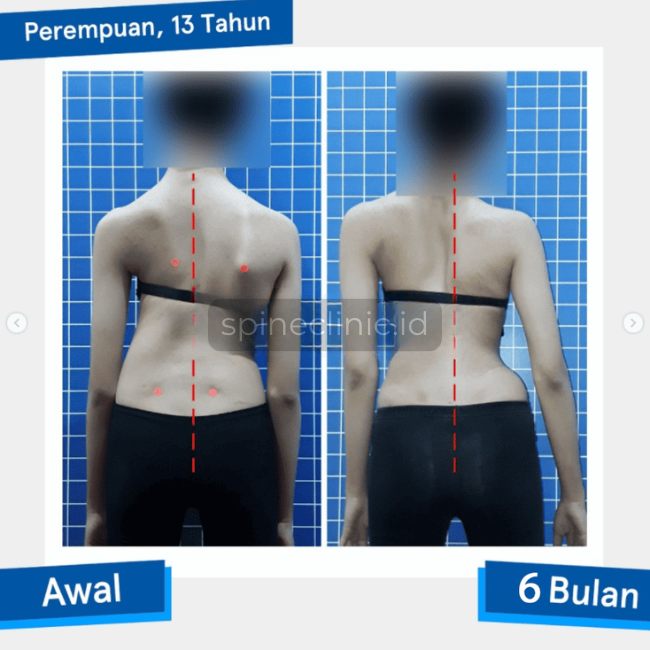 Studi Kasus Pada skoliosis dengan kelengkungan tinggi