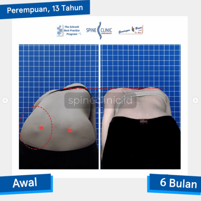 testimoni skoliosis berat sembuh